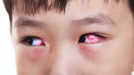 Tips to prevent dry eye